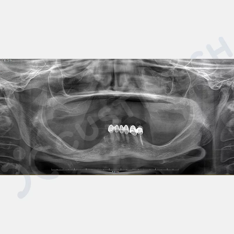custimesh-custimplant-subperiosteal-vaka1-1
