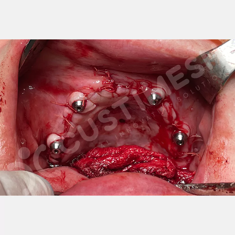 custimesh-custimplant-subperiosteal-vaka1-10