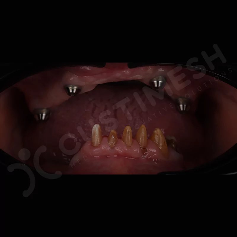 custimesh-custimplant-subperiosteal-vaka1-11