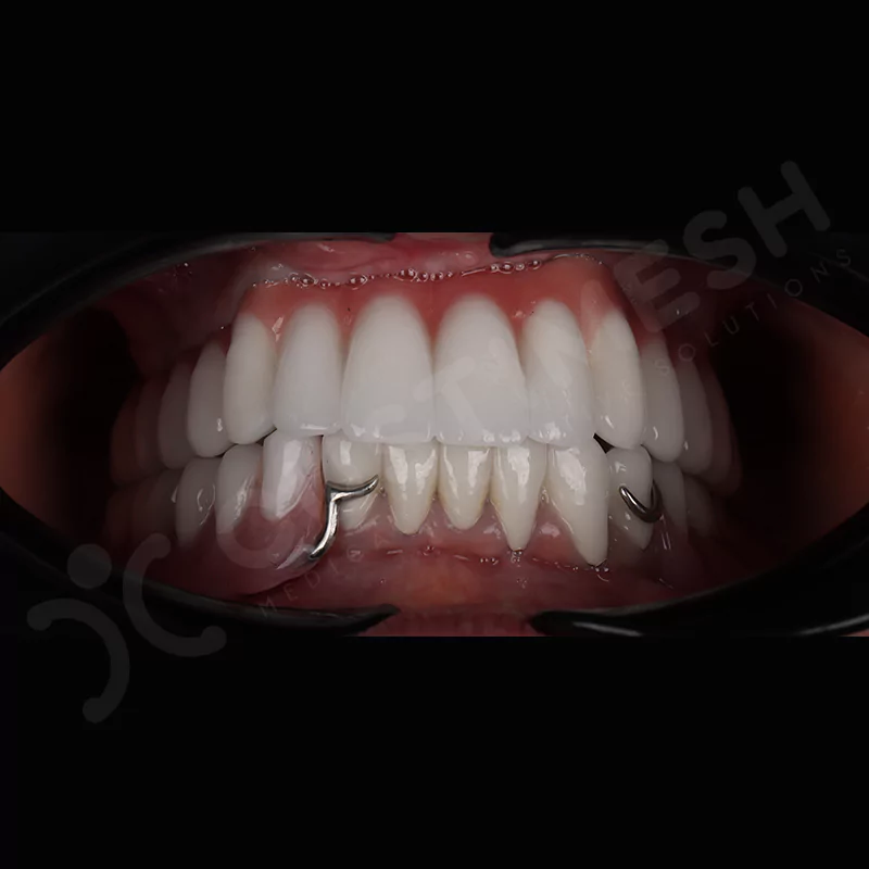 custimesh-custimplant-subperiosteal-vaka1-13