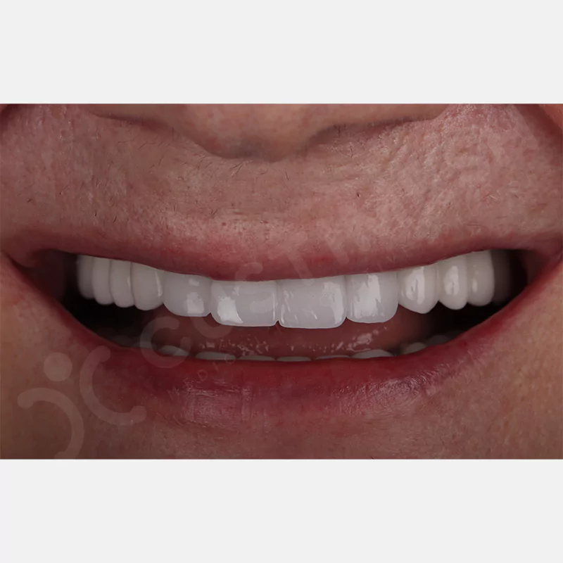 custimesh-custimplant-subperiosteal-vaka1-14