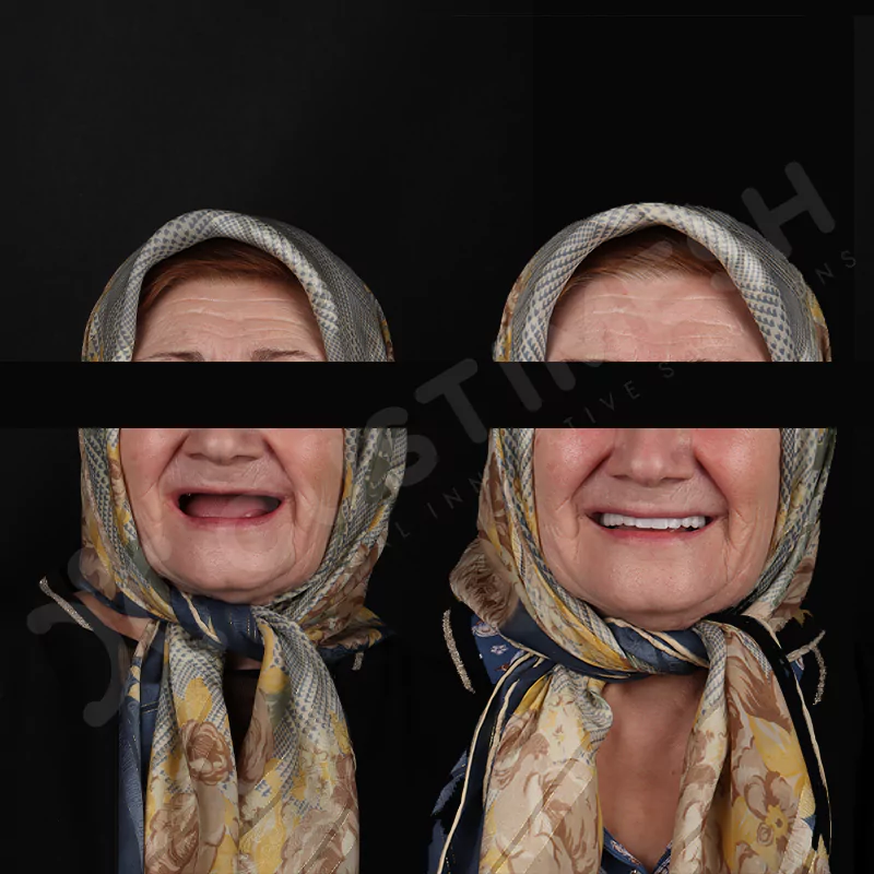 custimesh-custimplant-subperiosteal-vaka1-15