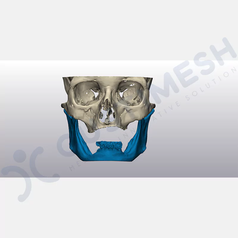 custimesh-custimplant-subperiosteal-vaka1-2