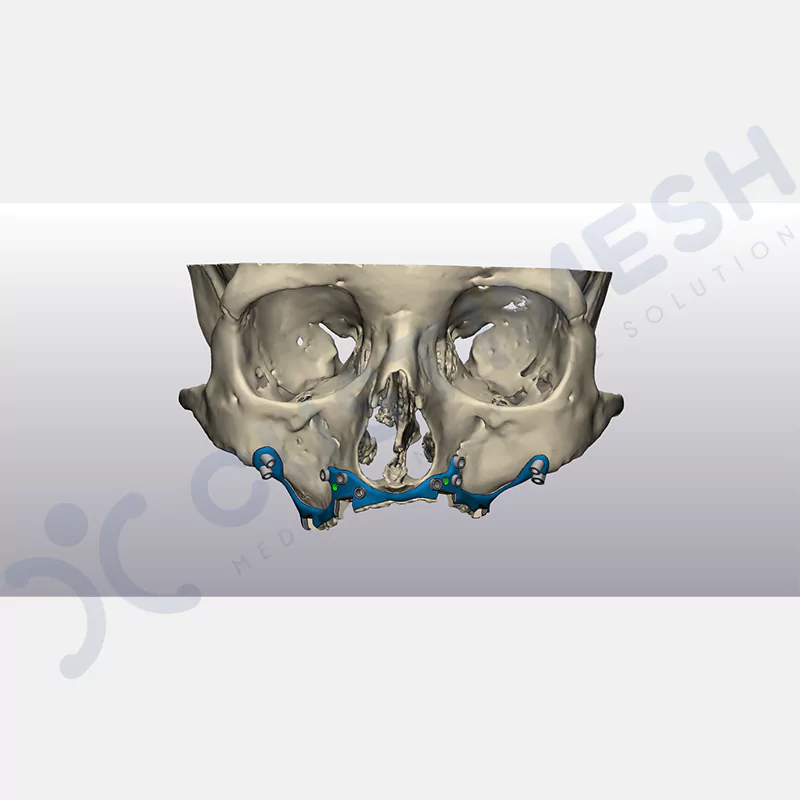custimesh-custimplant-subperiosteal-vaka1-3