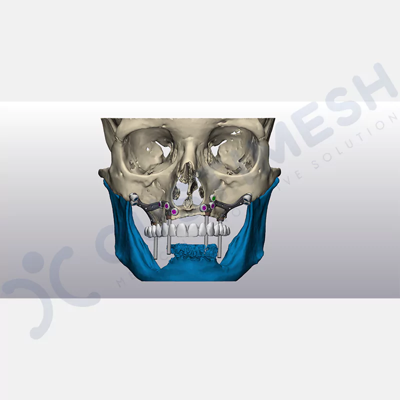 custimesh-custimplant-subperiosteal-vaka1-4