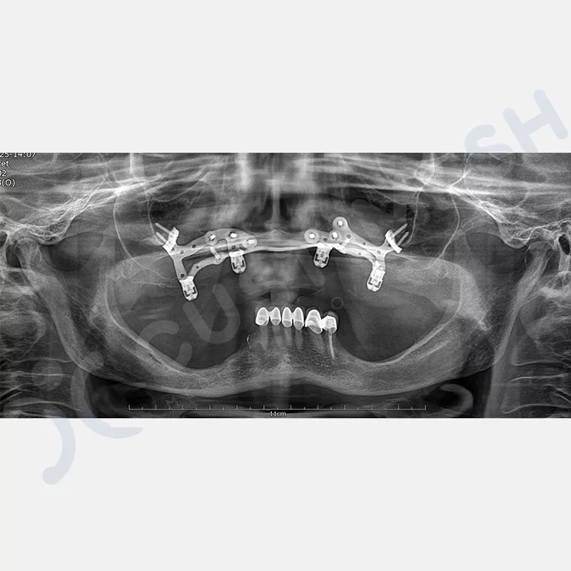 custimesh-custimplant-subperiosteal-vaka1-5