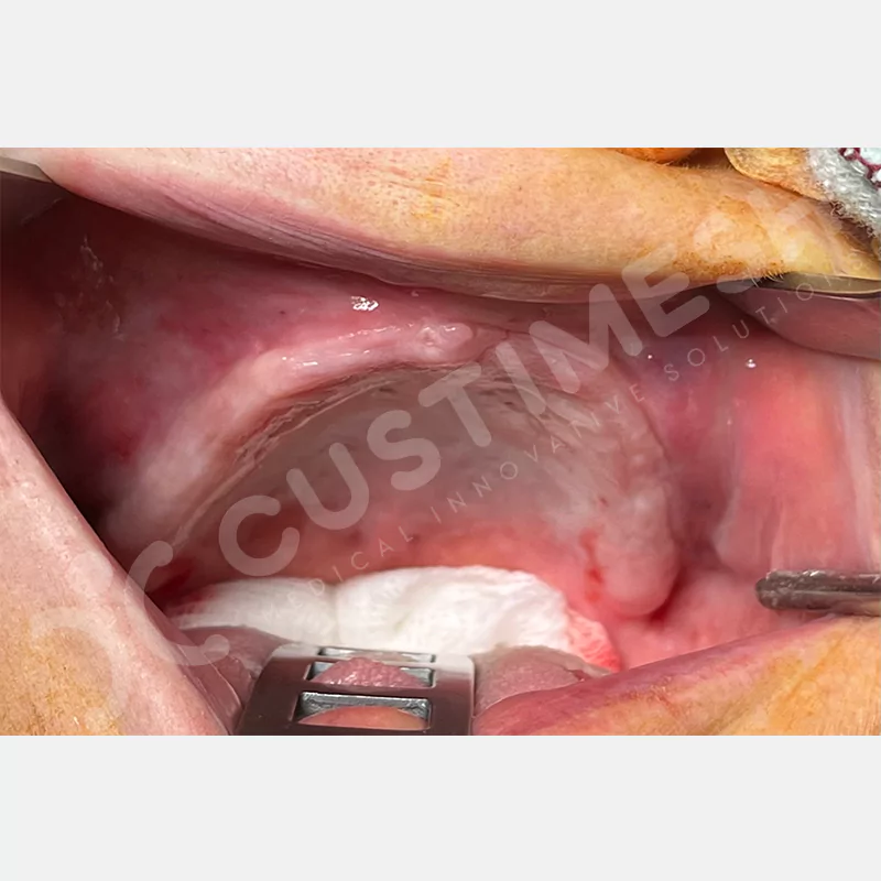 custimesh-custimplant-subperiosteal-vaka1-6
