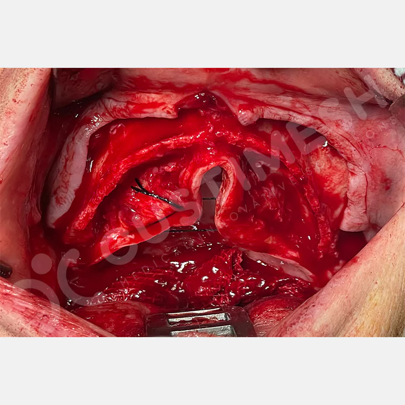 custimesh-custimplant-subperiosteal-vaka1-7