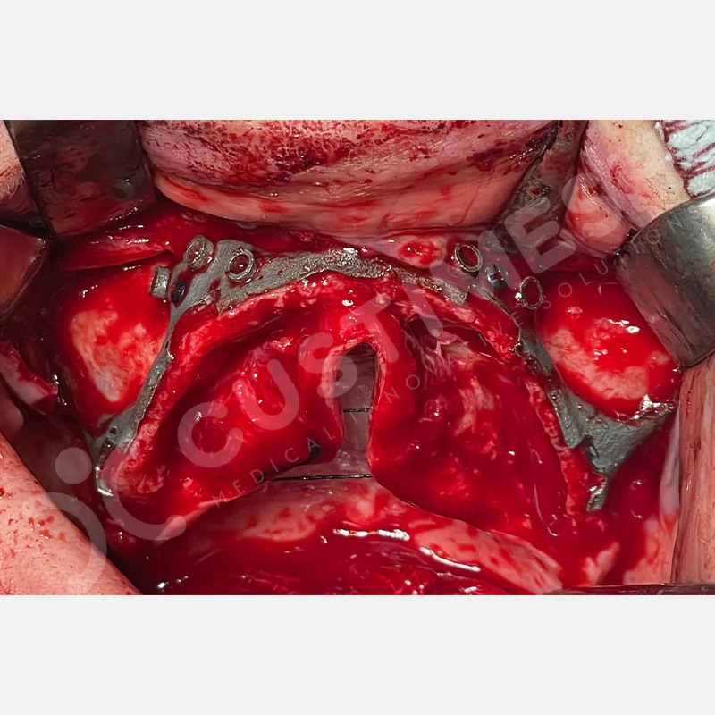 custimesh-custimplant-subperiosteal-vaka1-8