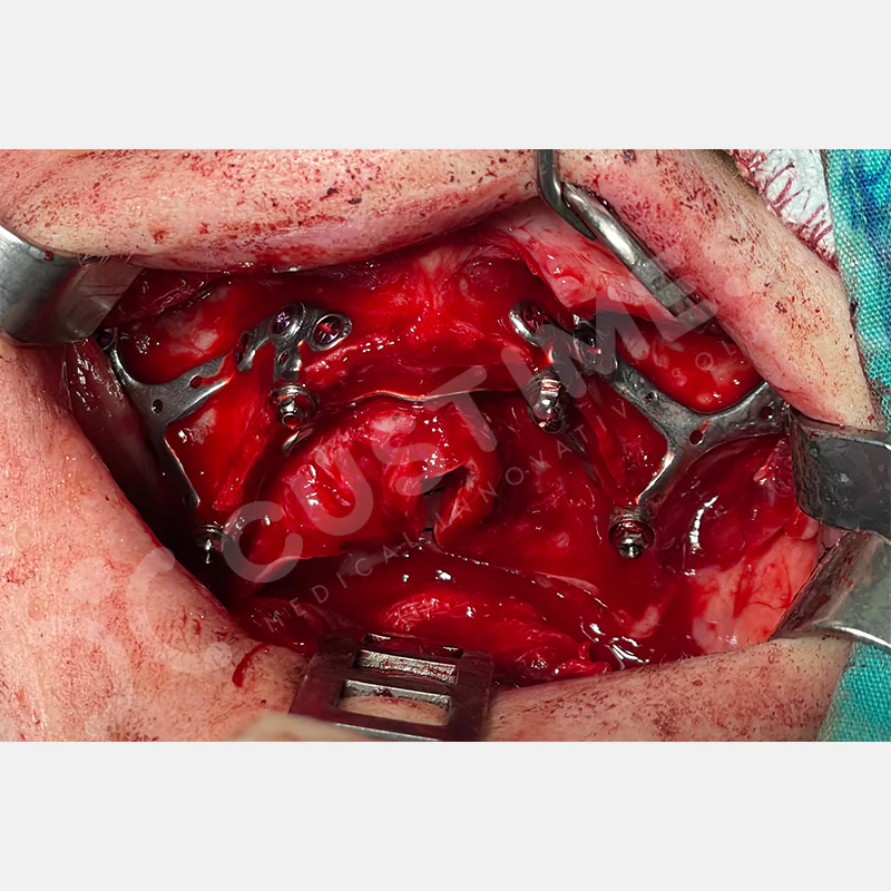 custimesh-custimplant-subperiosteal-vaka1-9