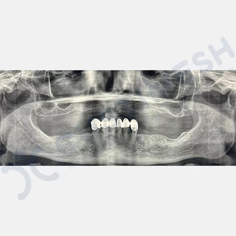 custimesh-custimplant-subperiosteal-vaka2-1