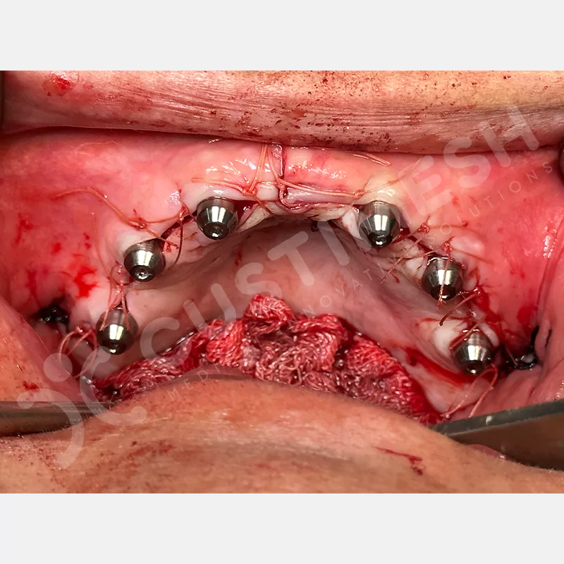 custimesh-custimplant-subperiosteal-vaka2-10