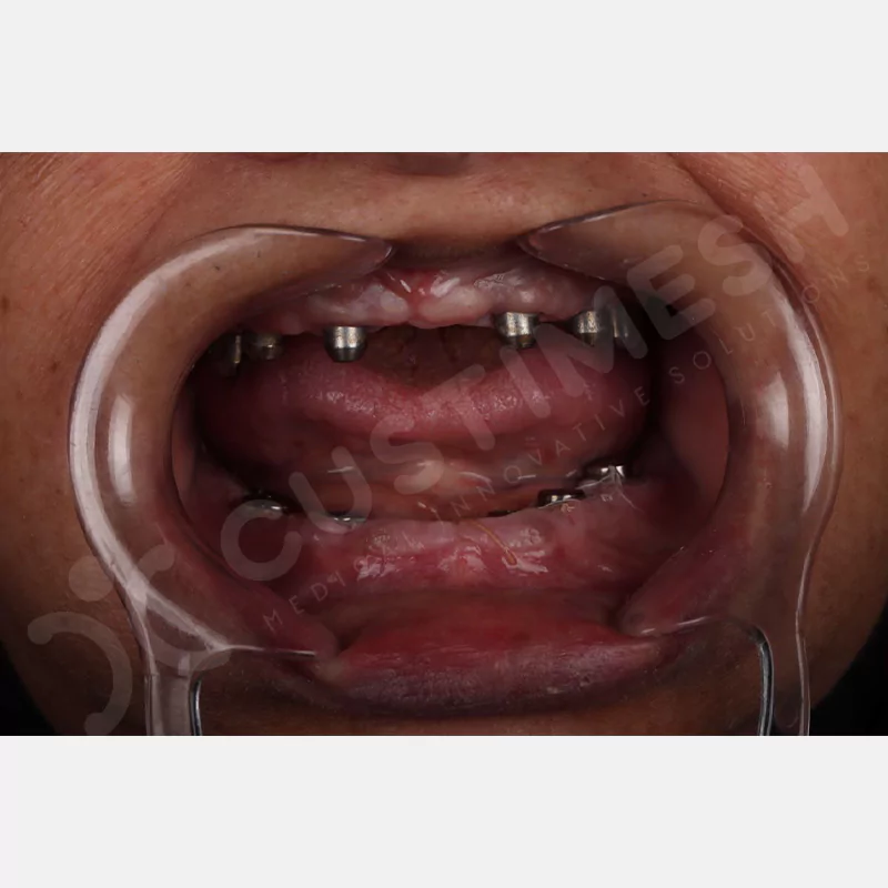 custimesh-custimplant-subperiosteal-vaka2-11