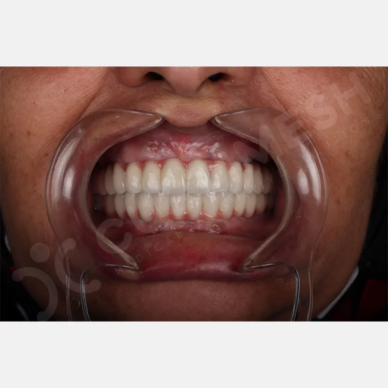 custimesh-custimplant-subperiosteal-vaka2-12