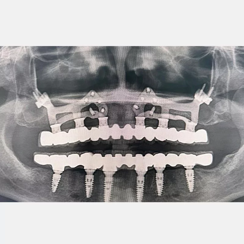 custimesh-custimplant-subperiosteal-vaka2-13