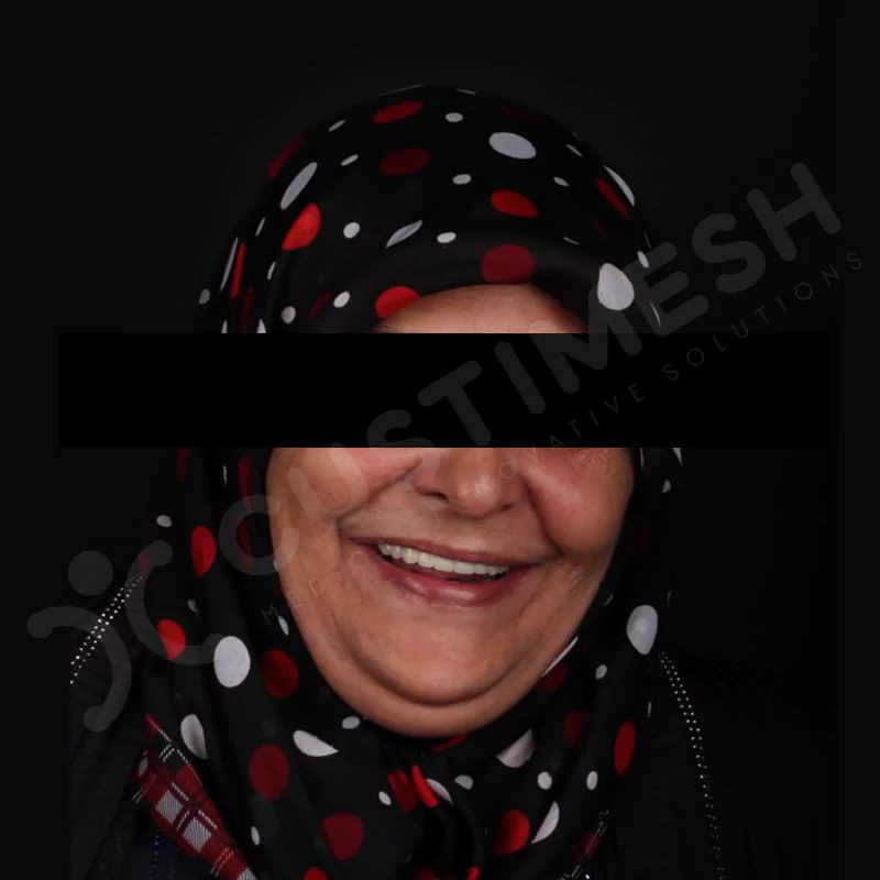 custimesh-custimplant-subperiosteal-vaka2-14