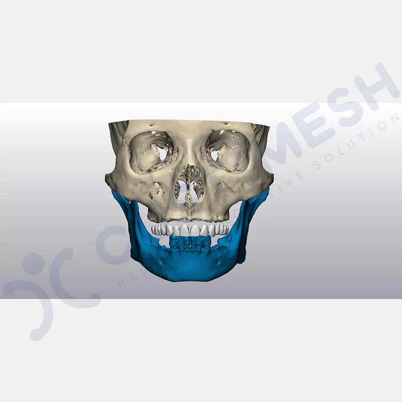 custimesh-custimplant-subperiosteal-vaka2-2