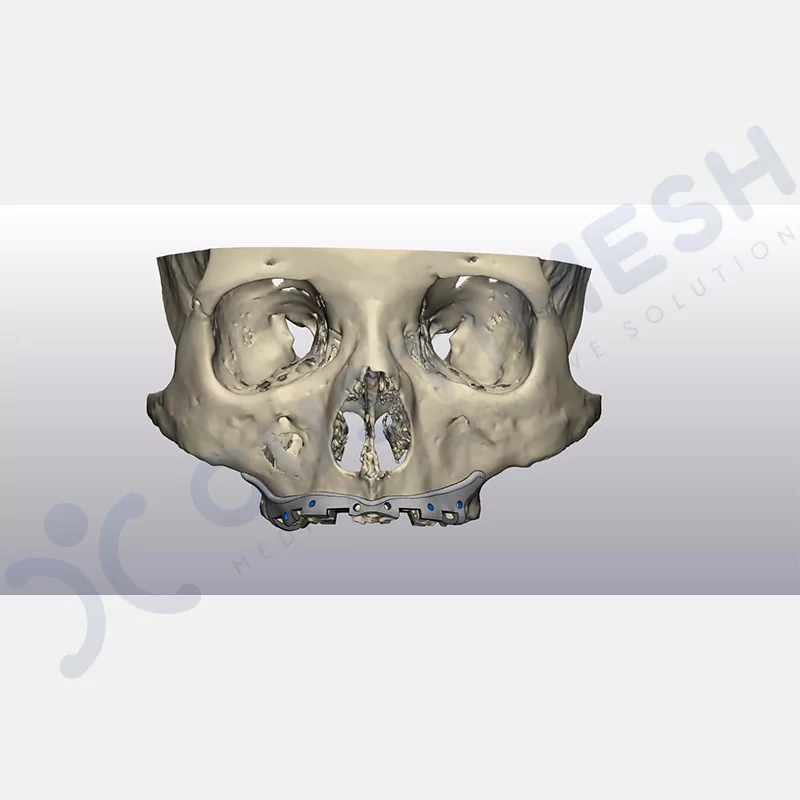 custimesh-custimplant-subperiosteal-vaka2-3