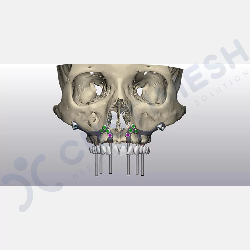 custimesh-custimplant-subperiosteal-vaka2-4