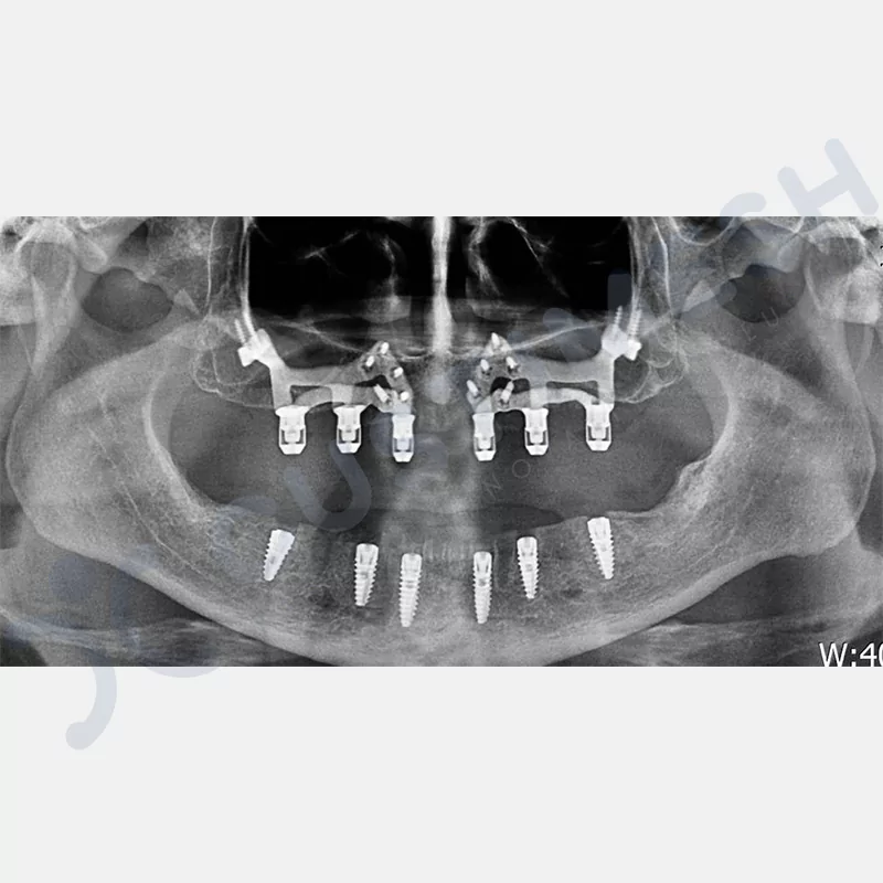 custimesh-custimplant-subperiosteal-vaka2-5