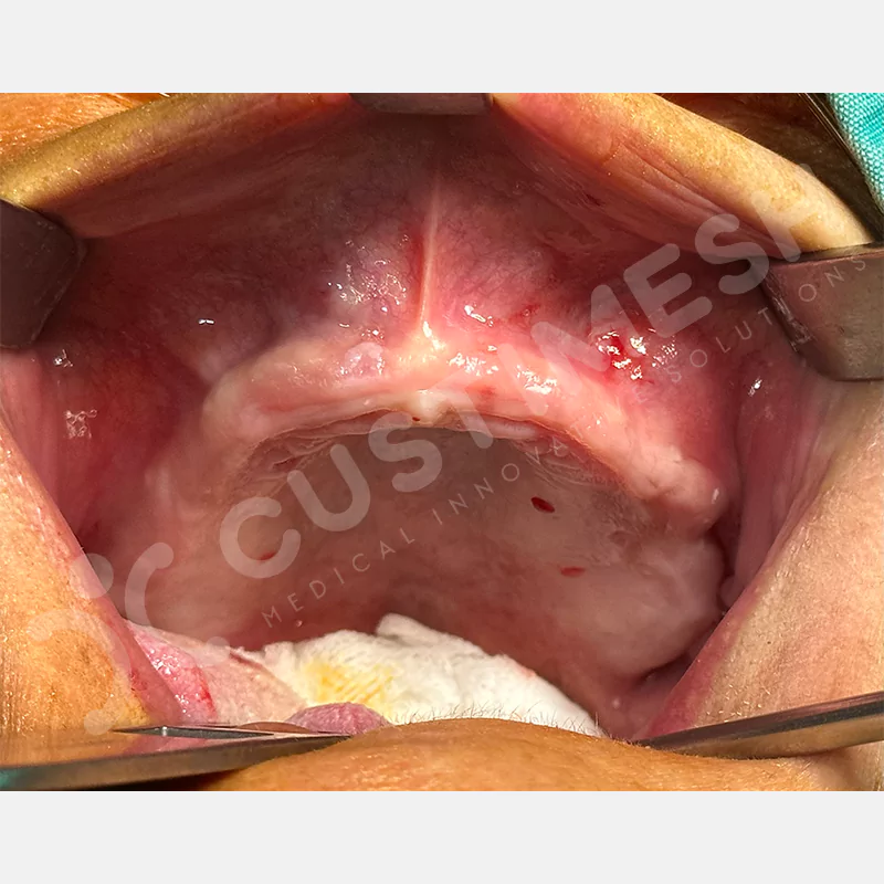 custimesh-custimplant-subperiosteal-vaka2-6