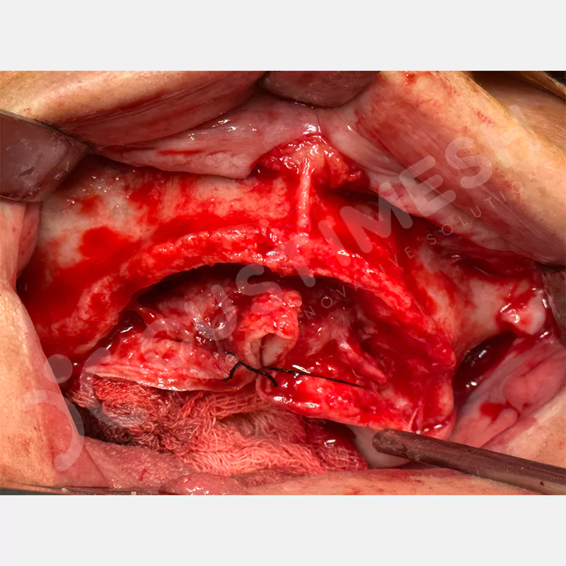 custimesh-custimplant-subperiosteal-vaka2-7