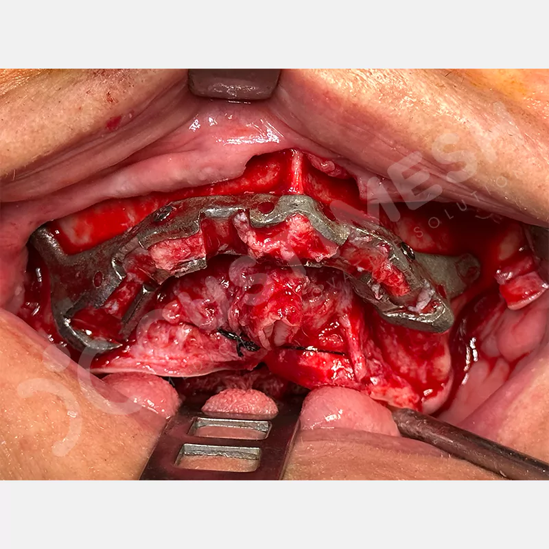 custimesh-custimplant-subperiosteal-vaka2-8