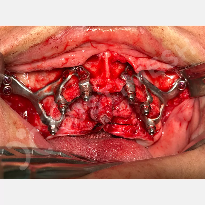 custimesh-custimplant-subperiosteal-vaka2-9