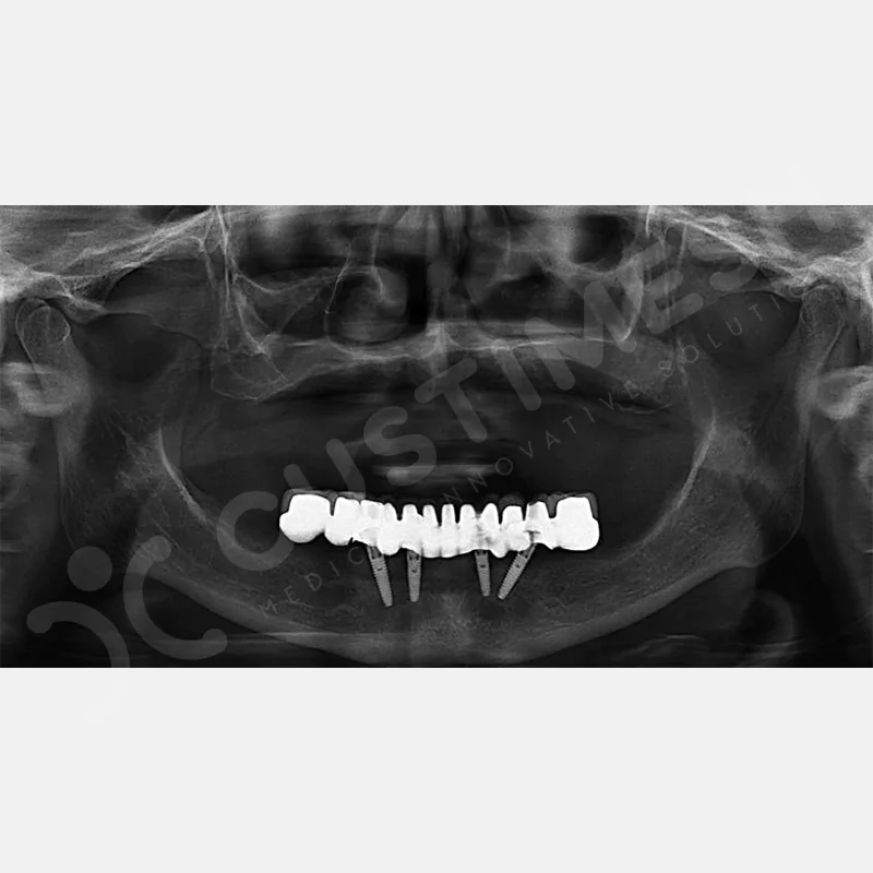 custimesh-custimplant-subperiosteal-vaka3-1