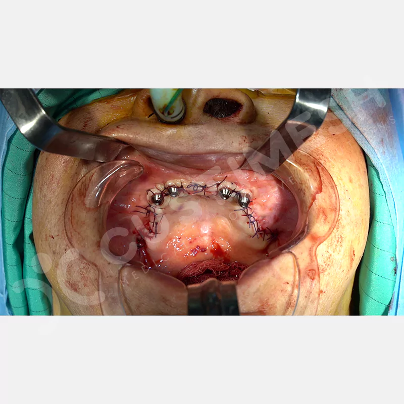 custimesh-custimplant-subperiosteal-vaka3-10