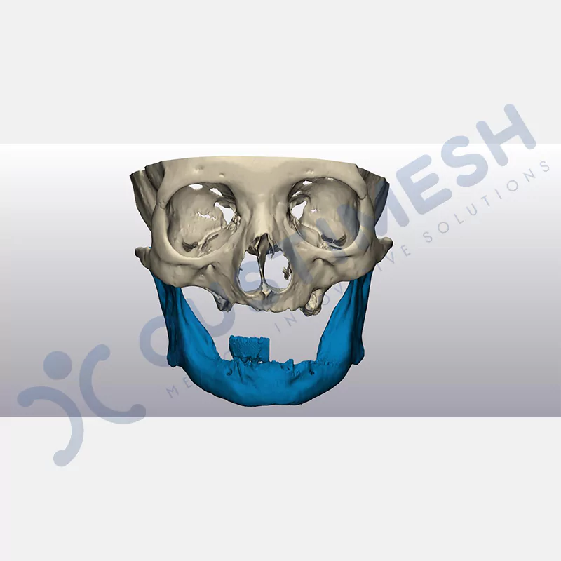 custimesh-custimplant-subperiosteal-vaka3-2