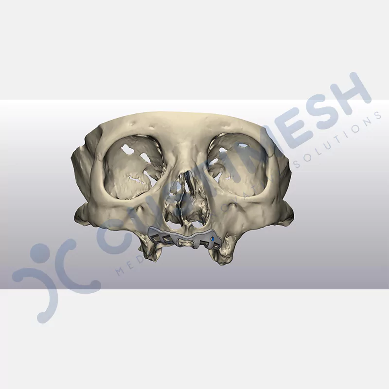 custimesh-custimplant-subperiosteal-vaka3-3