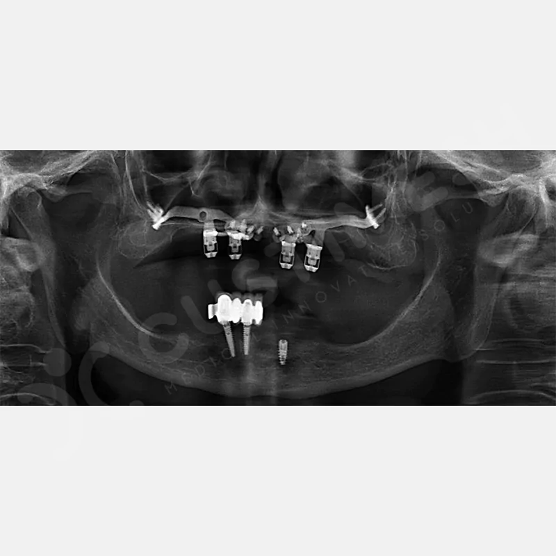 custimesh-custimplant-subperiosteal-vaka3-5