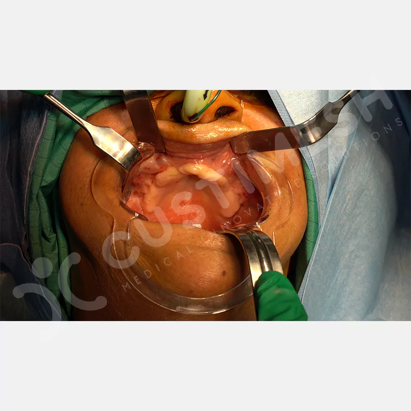 custimesh-custimplant-subperiosteal-vaka3-6