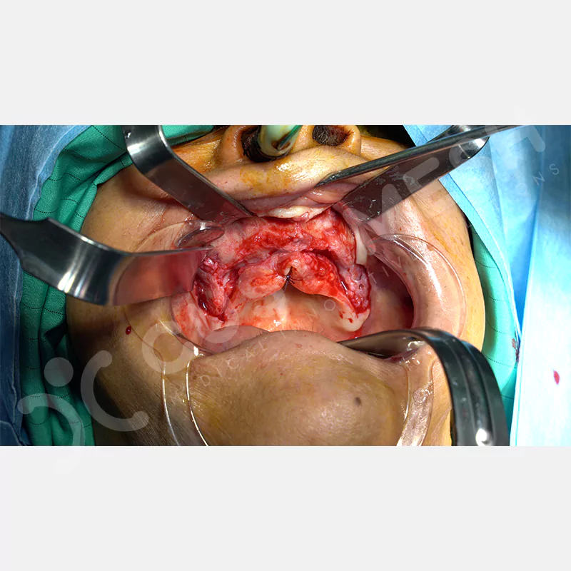 custimesh-custimplant-subperiosteal-vaka3-7