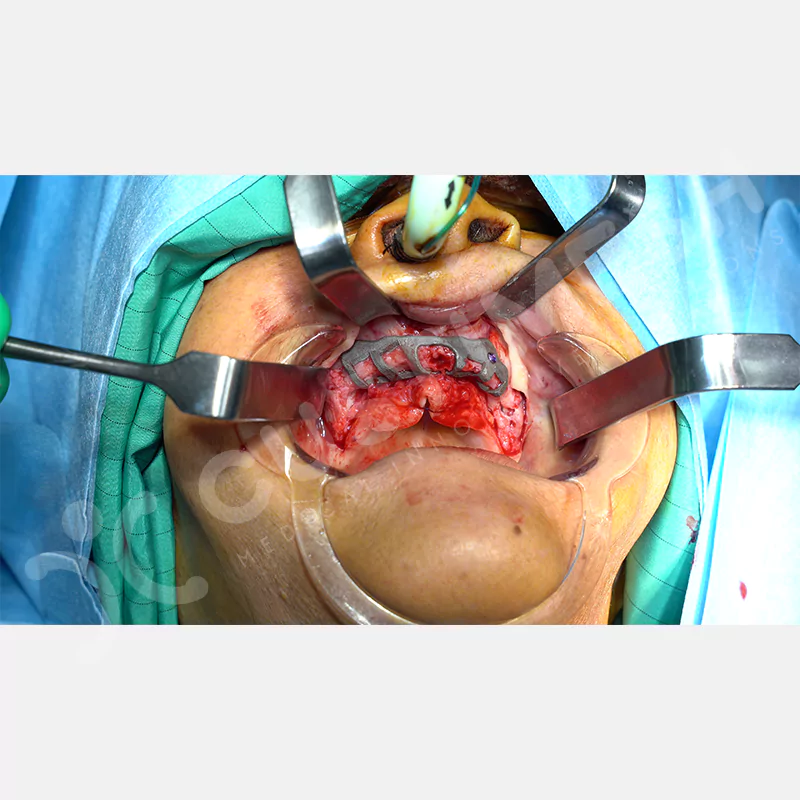 custimesh-custimplant-subperiosteal-vaka3-8