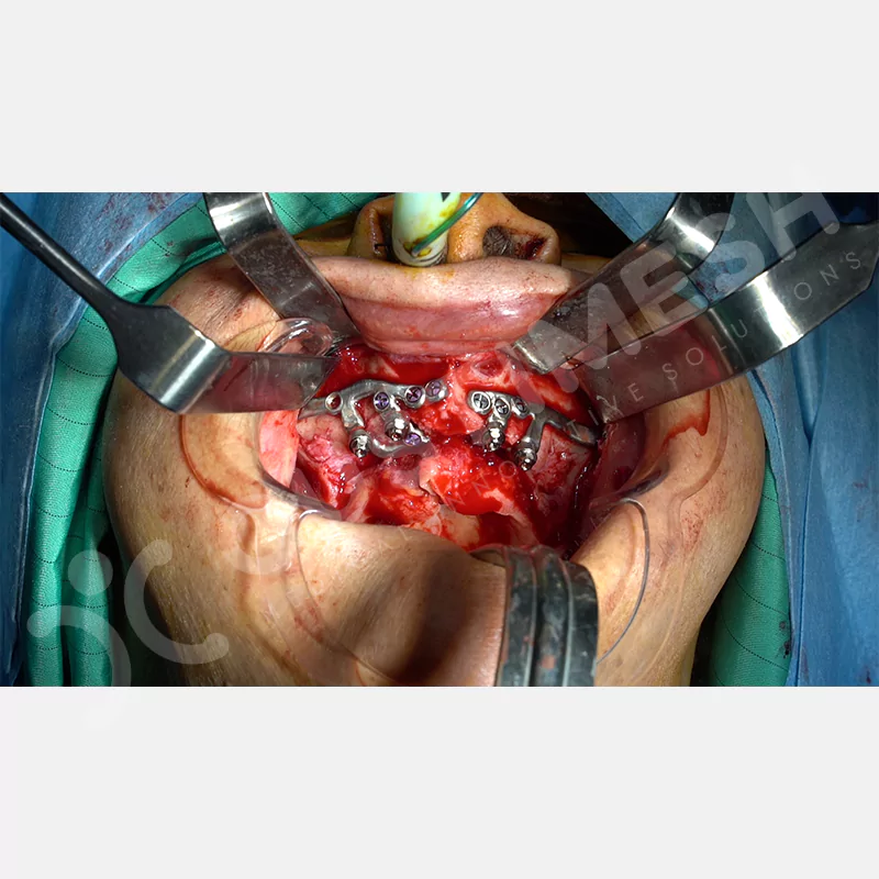 custimesh-custimplant-subperiosteal-vaka3-9