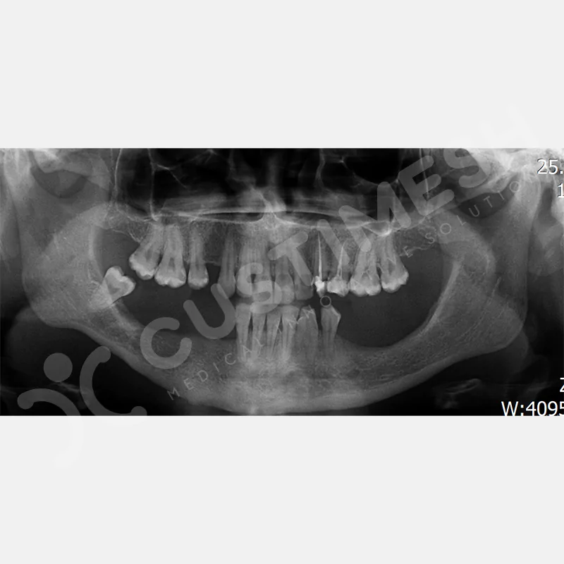 custimesh-custimplant-subperiosteal-vaka4-1