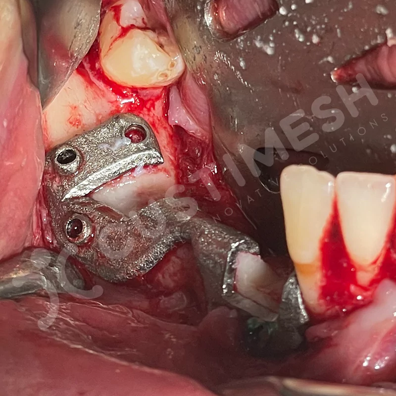 custimesh-custimplant-subperiosteal-vaka4-10