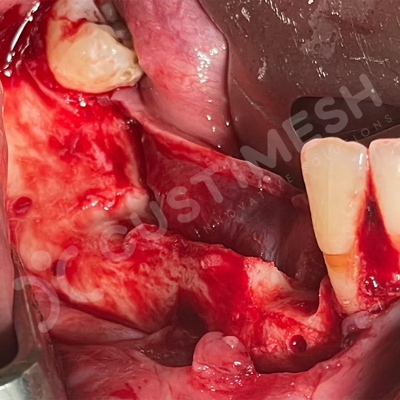 custimesh-custimplant-subperiosteal-vaka4-11