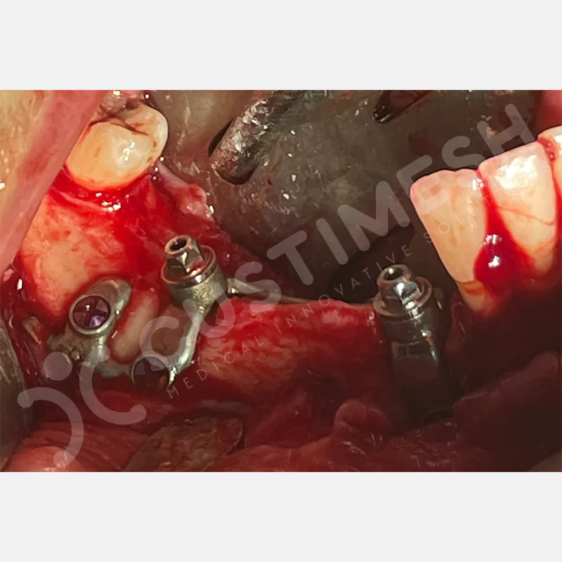 custimesh-custimplant-subperiosteal-vaka4-12