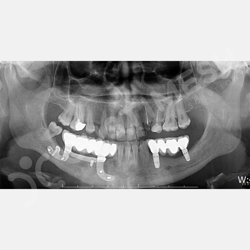 custimesh-custimplant-subperiosteal-vaka4-13