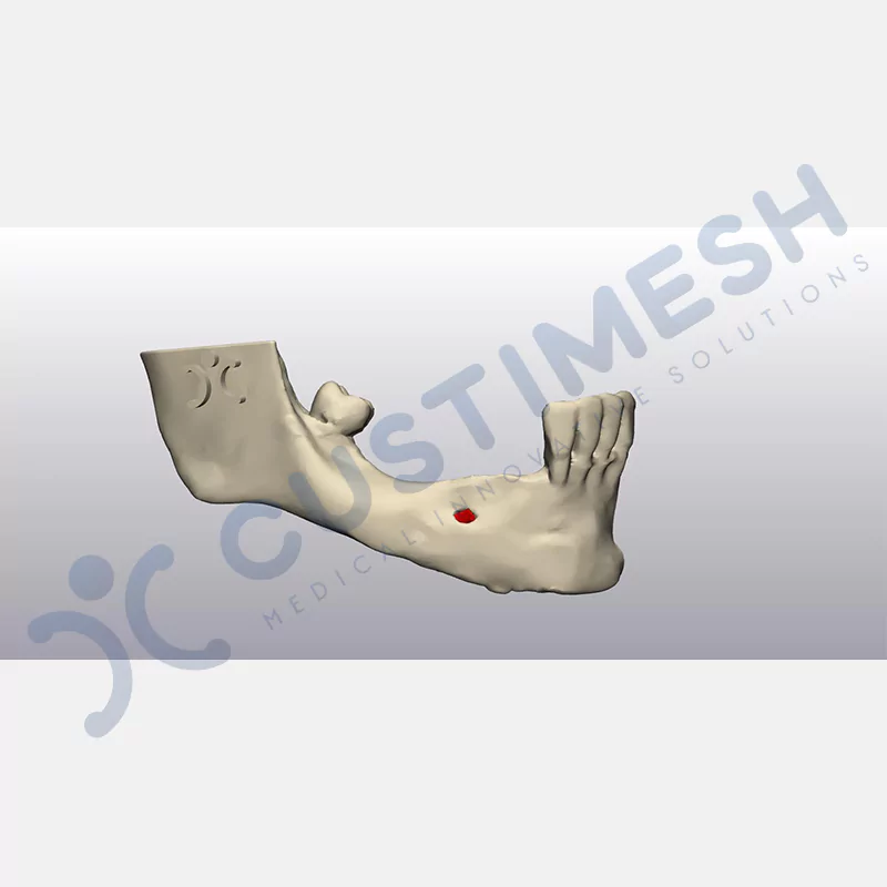 custimesh-custimplant-subperiosteal-vaka4-2