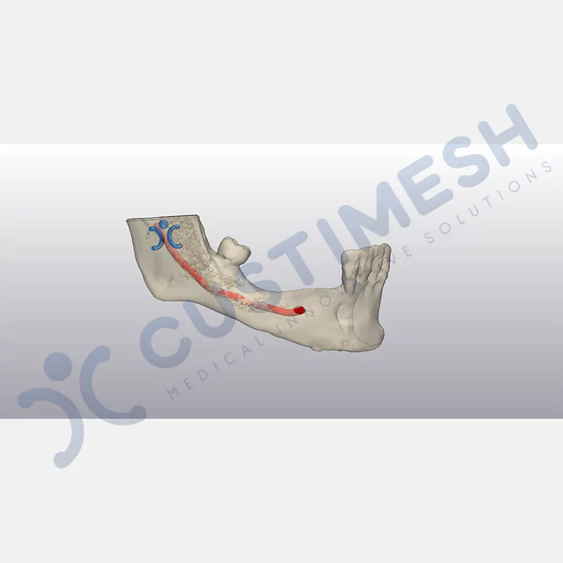 custimesh-custimplant-subperiosteal-vaka4-3