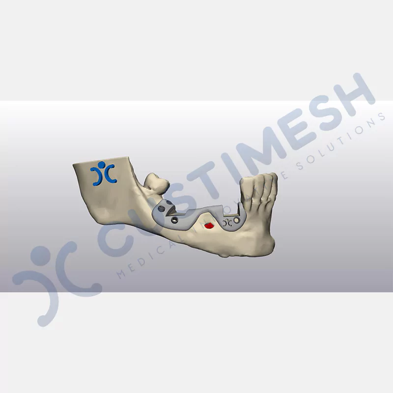 custimesh-custimplant-subperiosteal-vaka4-4