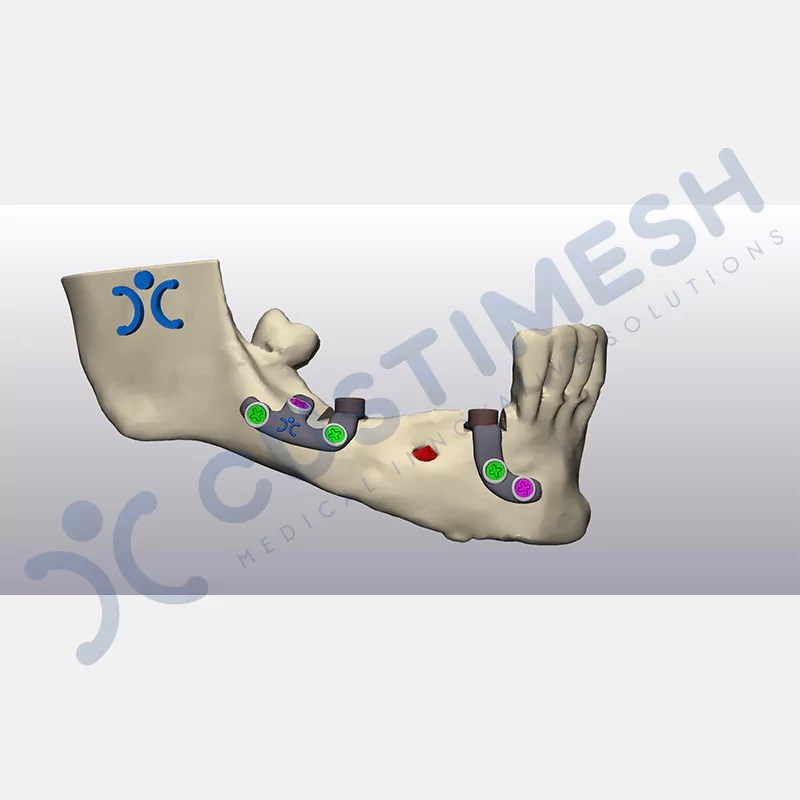 custimesh-custimplant-subperiosteal-vaka4-5