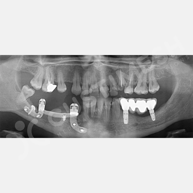 custimesh-custimplant-subperiosteal-vaka4-6