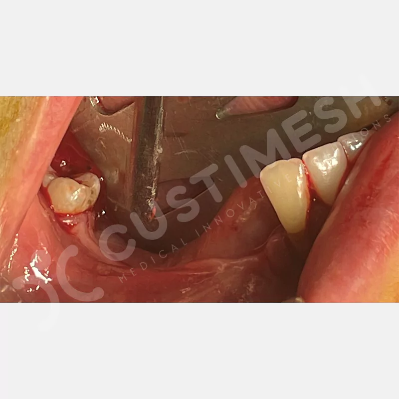 custimesh-custimplant-subperiosteal-vaka4-7