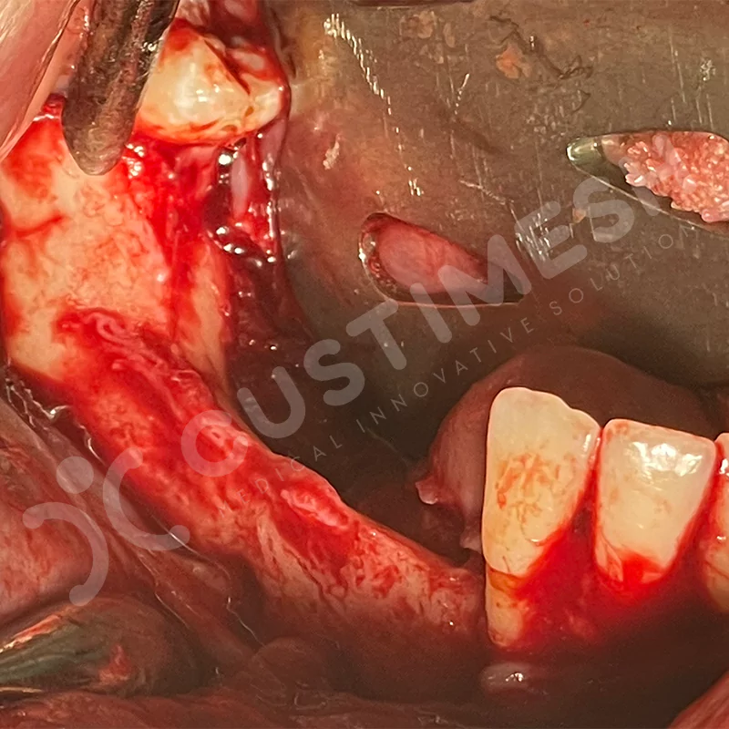 custimesh-custimplant-subperiosteal-vaka4-8