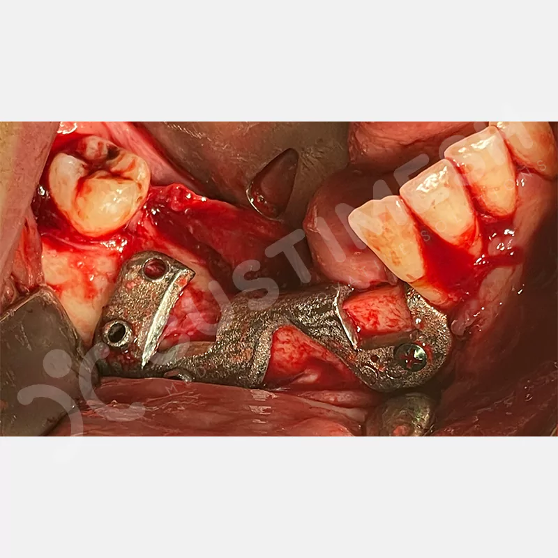 custimesh-custimplant-subperiosteal-vaka4-9